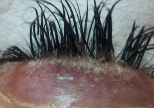 What Causes Eyelash Extensions to Fall Out?